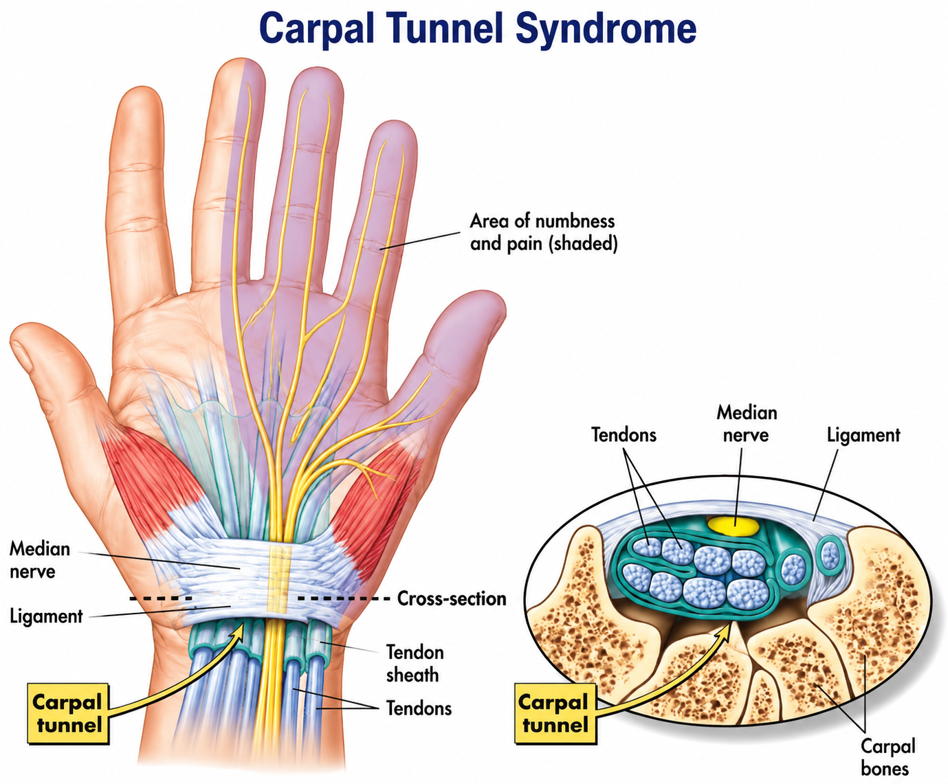 Carpal Tunnel Overview